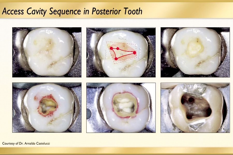 ACCESS CAVITY Posterior Access. Canal Preparation Dr. Troy McGrew