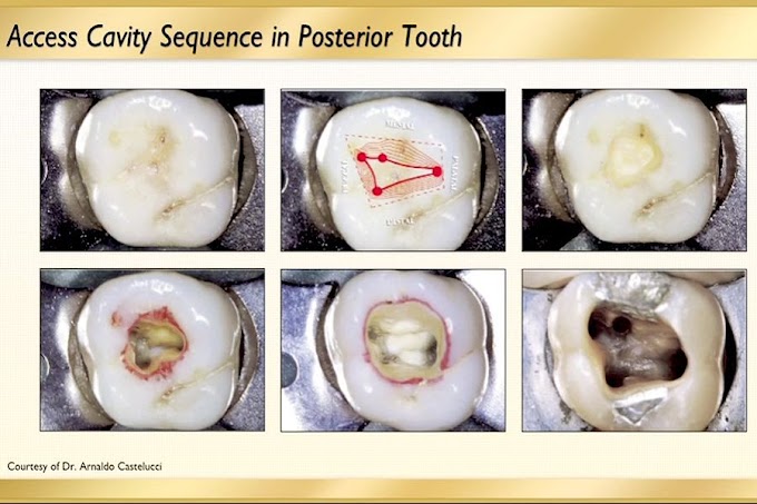 ACCESS CAVITY: Posterior Access. Canal Preparation - Dr. Troy McGrew