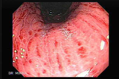 Cronica gastritis moderada inactiva antral