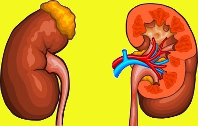 Penyebab,Gejala Penyakit Ginjal Bocor Serta Resiko Dan Bayahanya Penyebab,Gejala Penyakit Ginjal Bocor Serta Resiko Dan Bayahanya