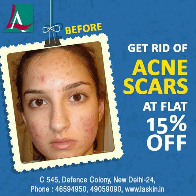 best acne scar treatment in south delhi India