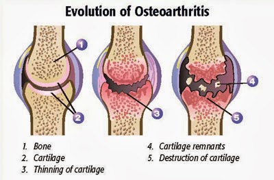 ICD 9 Code For Osteoarthritis