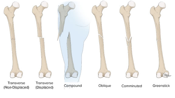 Types of bone fractures