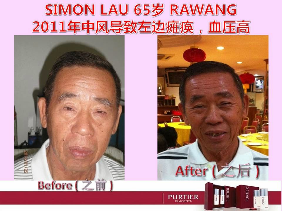 SIMON LAU (65) RAWANG - 2011 STROKE (LEFT SIDE PARALYSE), HYPERTENSION