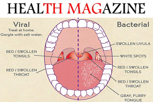 Causes And How To Treat A Sore Throat Health Magazine