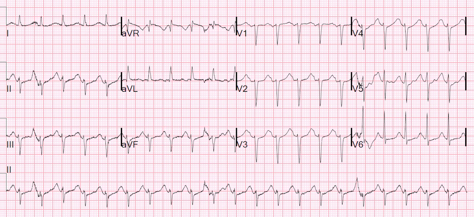 Dr. Smith's ECG Blog Alcohol withdrawal and sinus tachycardia