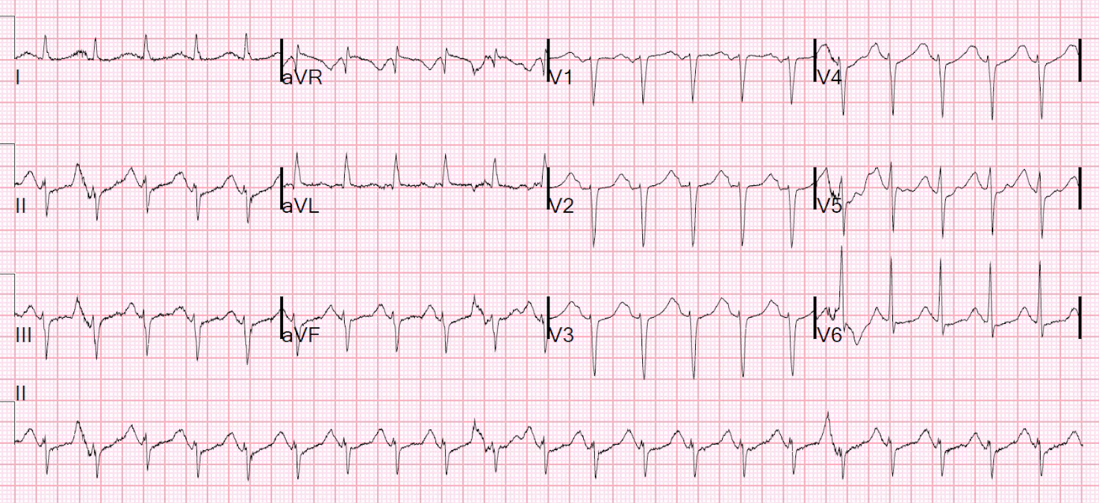 Dr Smith S Ecg Blog Alcohol Withdrawal And Sinus Tachycardia