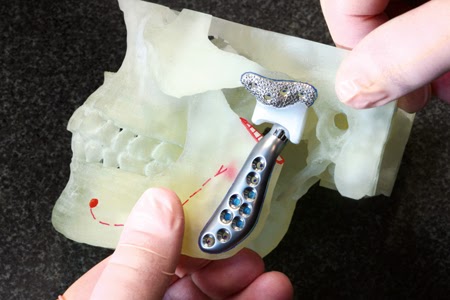 My TMJ replacement experience.: Total Concepts Implants