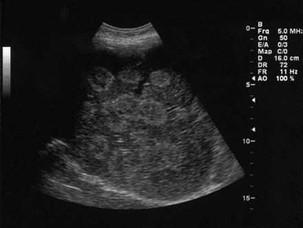 BÀI SOẠN VỀ SIÊU ÂM CHẨN ĐOÁN: DẤU MẮT BÒ và DẤU HÌNH BIA ĐẢO NGƯỢC ở GAN