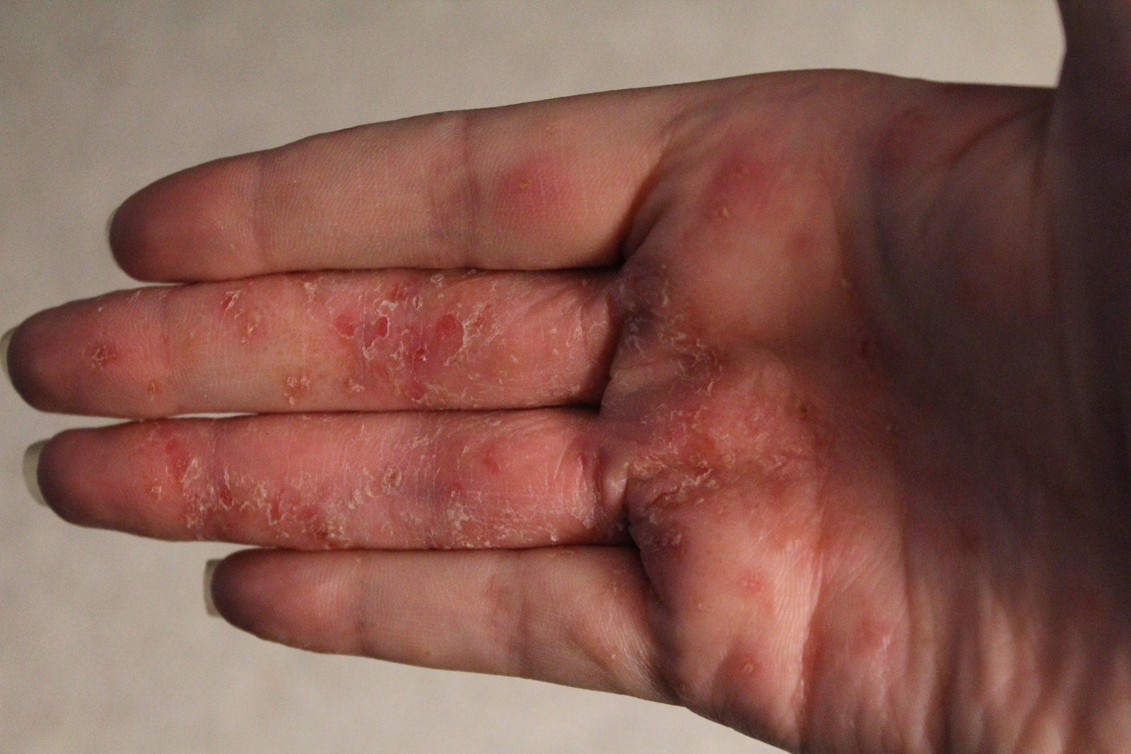 Pompholyx : National Eczema Society