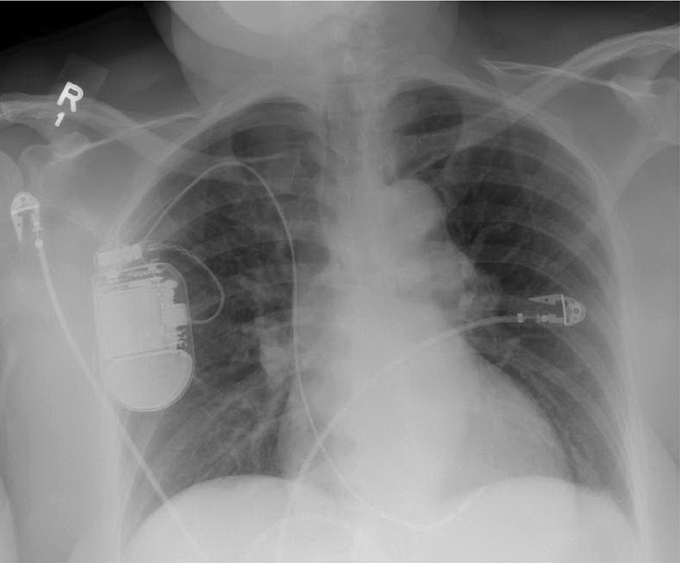 Focus on ECGs Case 9 — Evaluation of Chest Pain after Implantable