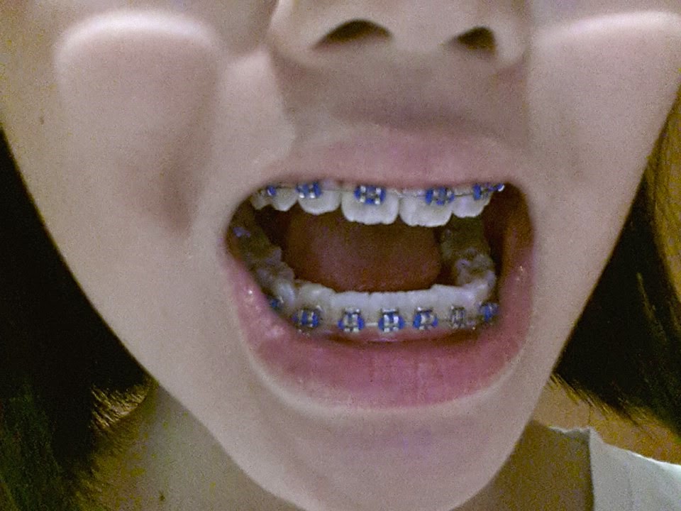 braces journey geraldine yan