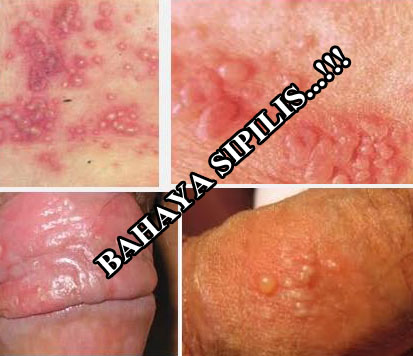 Situs Obat Herbal Manjur Ambeine Menyembuhkan Sipilis Cepat Dan Aman Dengan Obat