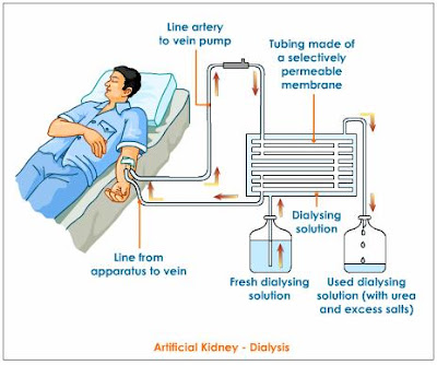 dialysis kidney hemodialysis renal artificial failure parenchymal disease works peritoneal machine parts does cvvh treatment know center common things blood