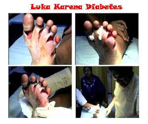 mengeringkan luka penderita diabetes melitus
