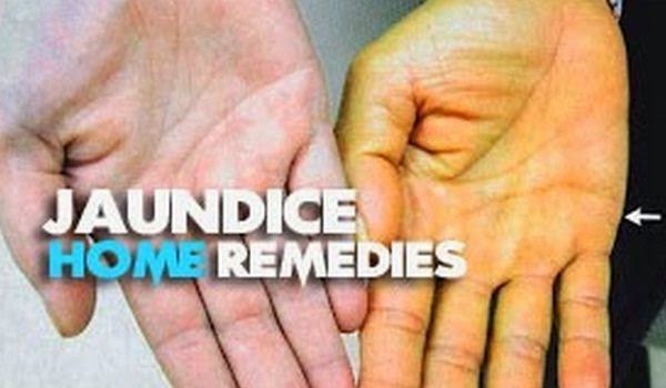 How To Treat Jaundice In Adults 121