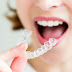 Khách hàng biết thông tin gì về phương pháp niềng răng invisalign?