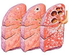 Como deteriora los pulmones | La tuberculosis