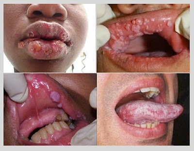 Infection caused by oral sex