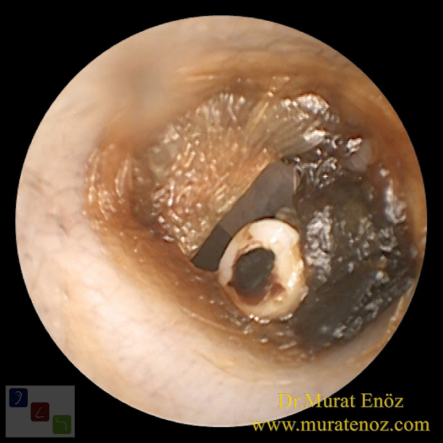 How does the ear tube fall out? - Some ear tubes can sponteously fall out? - What is an ear tube and what does it do? - Ensuring air transfer to the middle ear with ear tubes (ventilation) - When are ear tubes used? - How does the ear tube fall out? - If the ear tube fall out early ... - Symptoms of fall out early of ear ventilation tubes from eardrum - Does the ear tube cause pain as it falls? - What happens if the ear tube does not fall? - Damages of the ear tube - Ear tubes - Ear tube falls out - Ear tube removal - Ear ventilation tubes