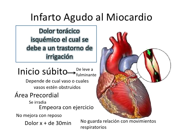 Porque se produce un infarto agudo al miocardio