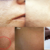 How to get rid of Large OPEN PORES permanently and Acne Scars Naturally At Home