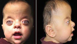 A six-month-old child with Apert syndrome image