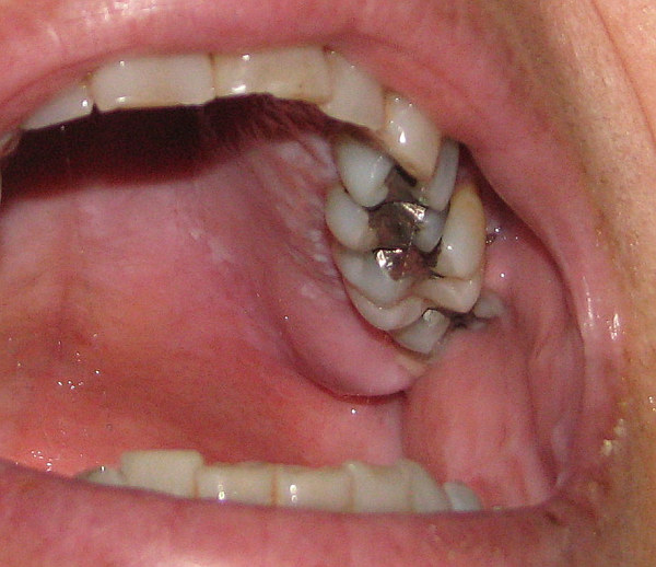 Roofing Swollen Roof Of Mouth