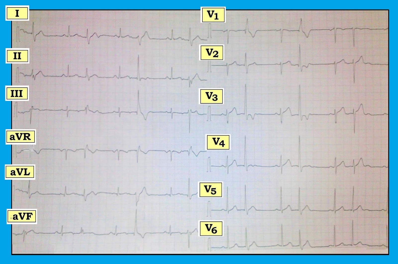 ECG Interpretation ECG Blog 140 (PVC Atrial Bigeminy PAC LAHB