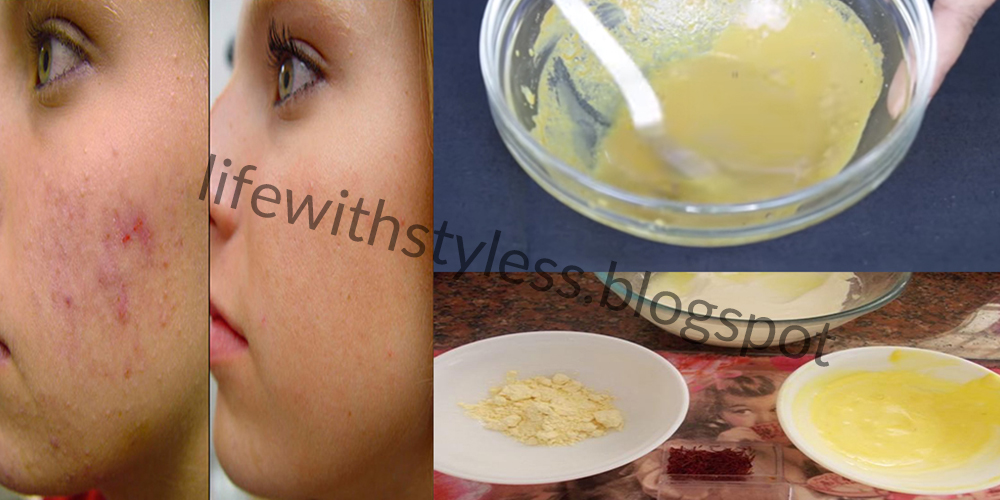 Homemade Acne Mask for skin lightening overnight Life With Styles