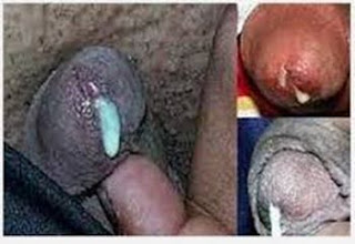 Obat kencing nanah yang alami, pengobatan sifilis wanita, obat gonore (kemaluan bernanah) yang ampuh, masa inkubasi penyakit gonorrhea adalah, obat tradisional untuk gonore (kemaluan keluar nanah), jual obat gonore (kemaluan keluar nanah), fase penyakit kencing nanah, obat oral kencing nanah, cara menular sifilis, obat untuk kencing nanah di apotik, penyakit gonore bisa kambuh lagi