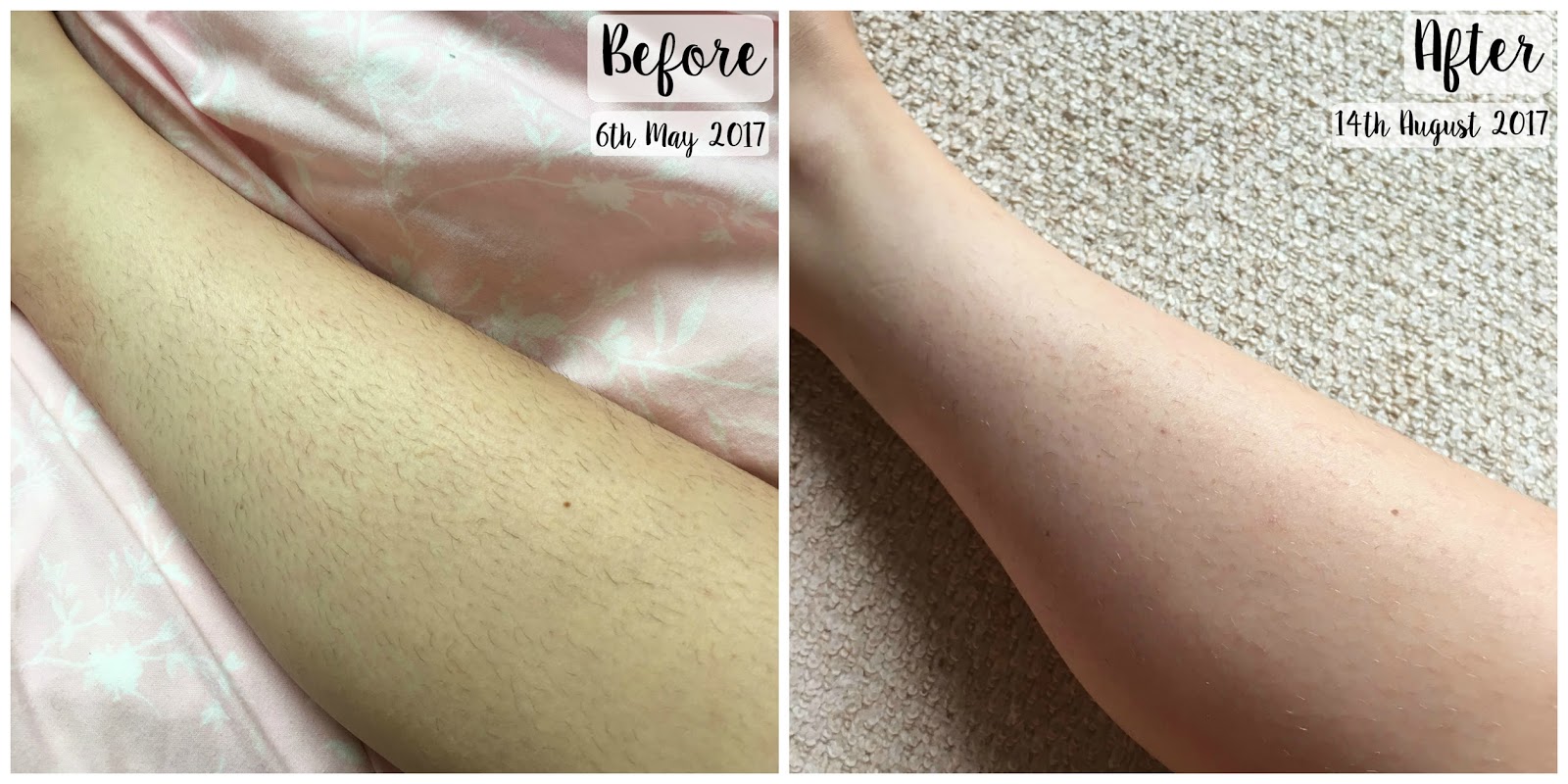 Tria Hair Removal Laser 4X G Beauty
