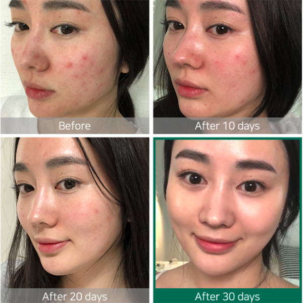 Review Some By Mi Aha Bha Pha 30 Days Miracle Toner Firda Skin Journey
