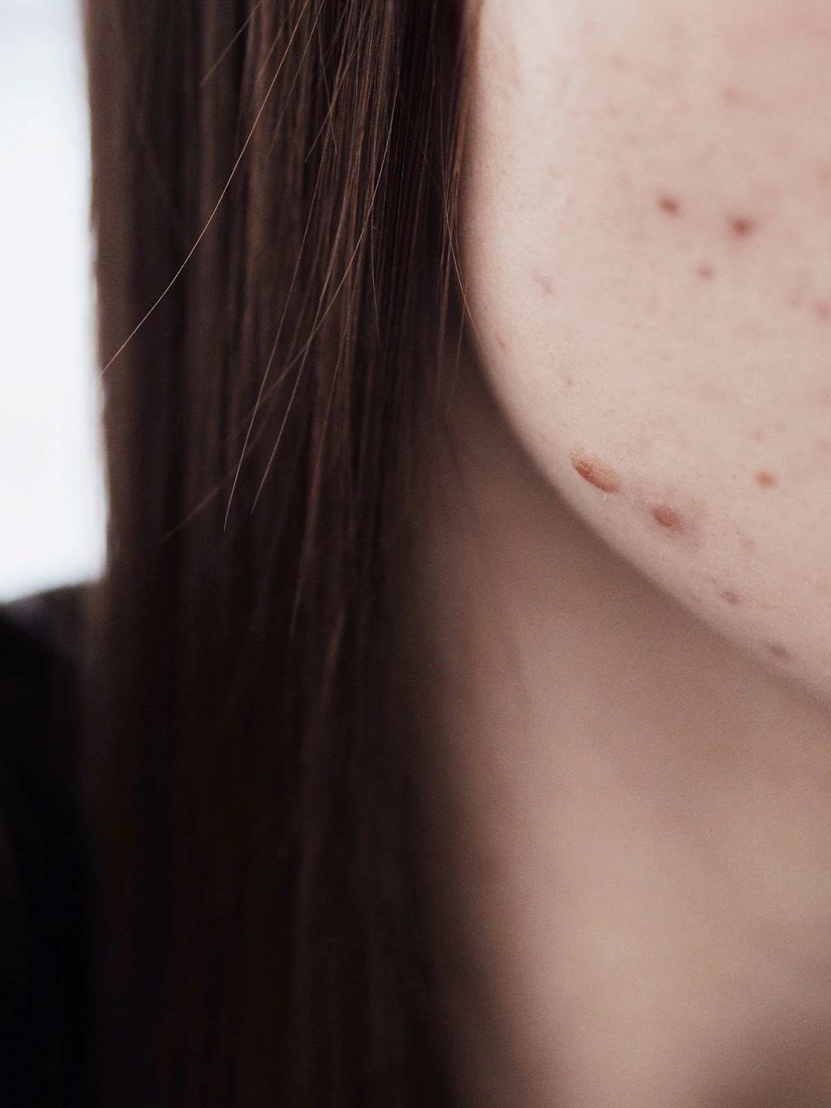 Does It Work For Spots? Skyn Iceland Blemish Dots With Salicylic Acid