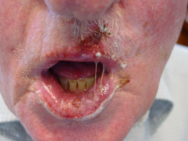 herpes above lip #11