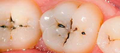 Đau răng sâu nên làm gì? 