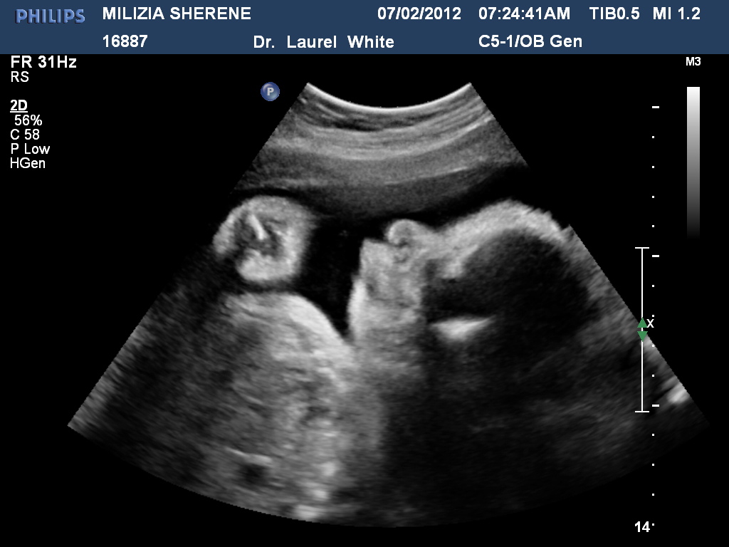 Days of our lives... 32 weeks Ultrasound