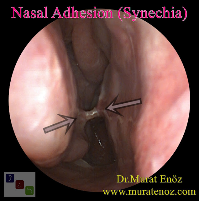 Intranasal Synechia - Intra-nasal Adhesion - Nasal adhesion - Radiofrequency Turbinate Reduction Risks - Radiofrequency Turbinate Reduction Complications