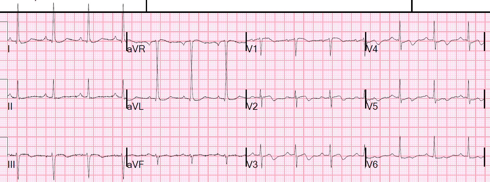 This demonstrates how Wellens' waves manifest the aftermath of a reperfused STEMI