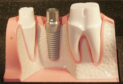 Trồng răng implant có đắt không?