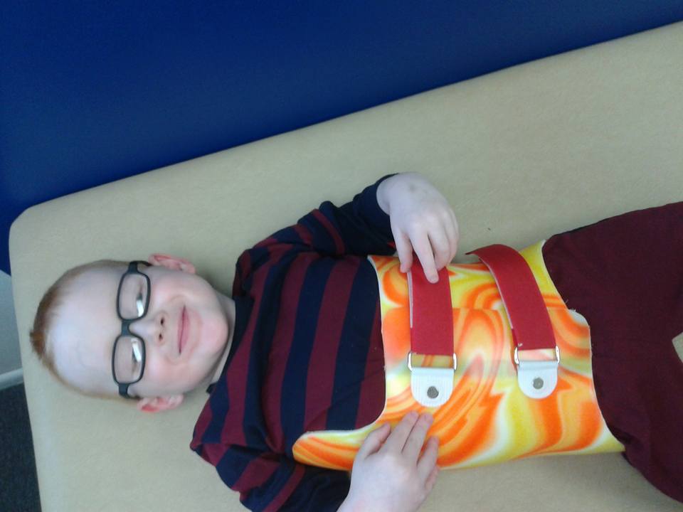 Mason's Spina Bifida Journal Scoliosis Brace Night bending brace