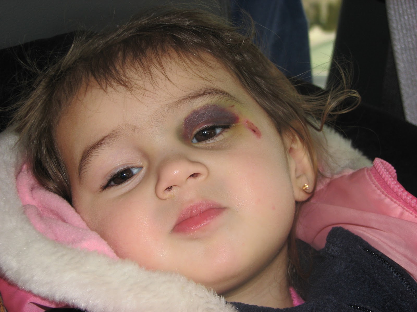 Zarr Family Blog: Gianna's First Bad Boo Boo