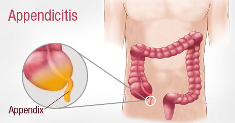 Symptoms Of Appendicitis In Adults Symptoms Of Appendicitis In Adults