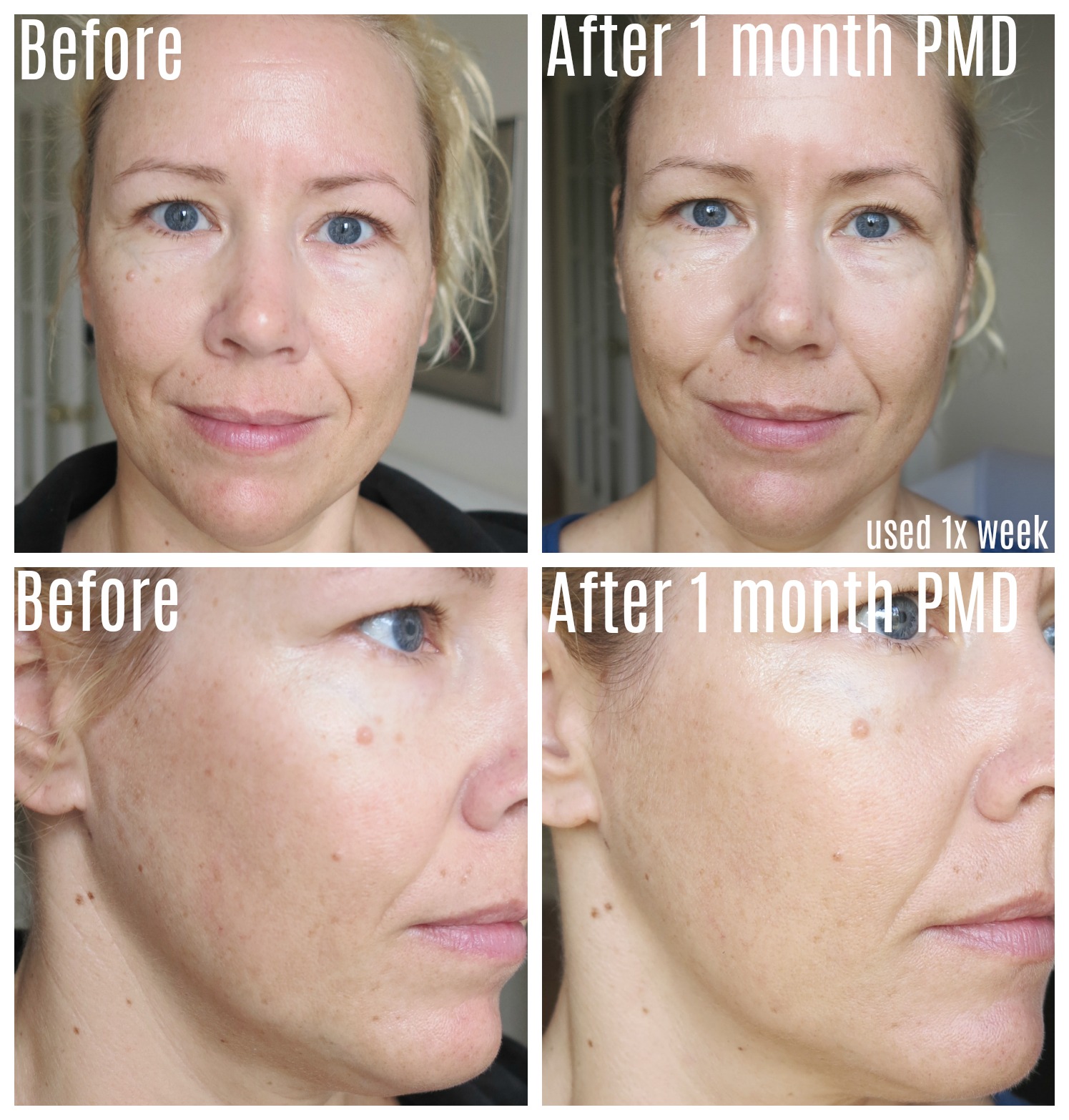 PMD PERSONAL MICRODERM 1 MONTH UPDATE WITH BEFORE AFTER PICTURES!