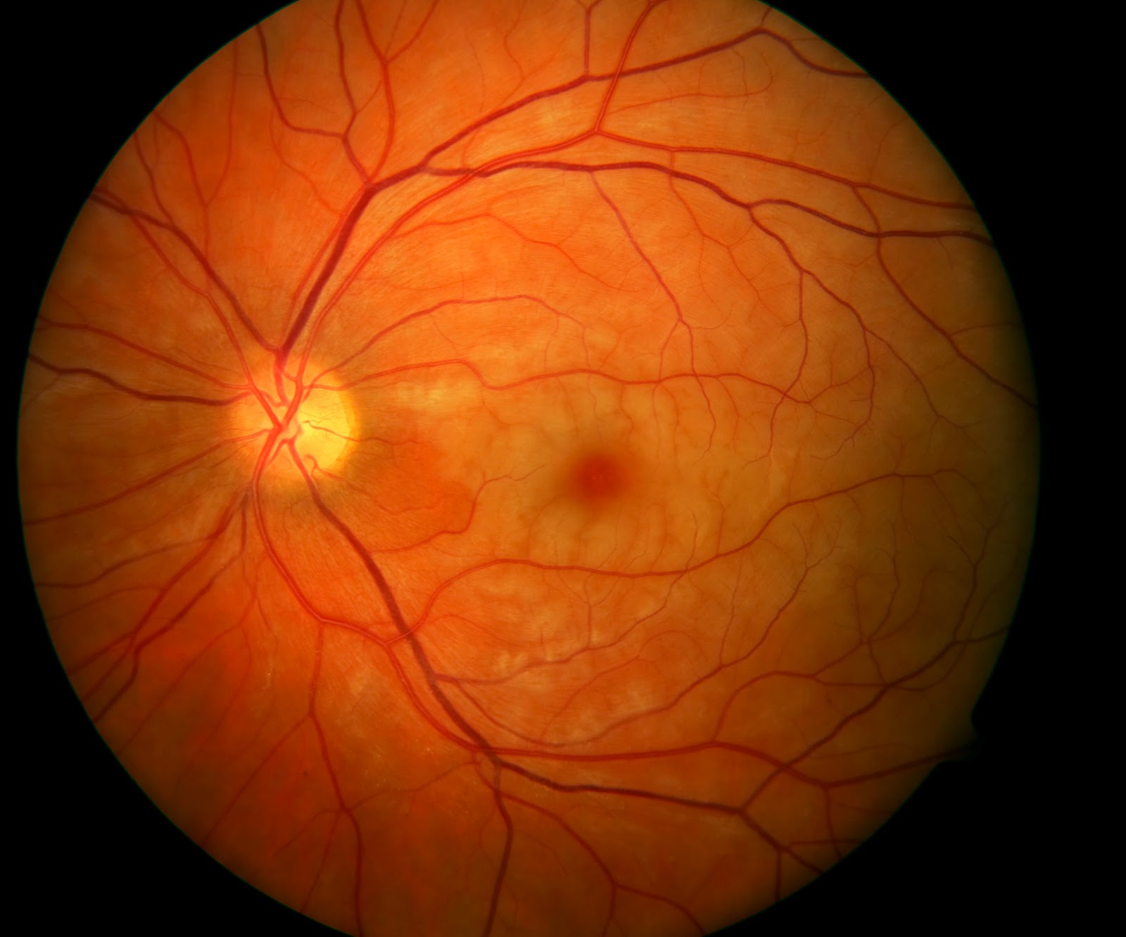 абиотрофия сетчатки