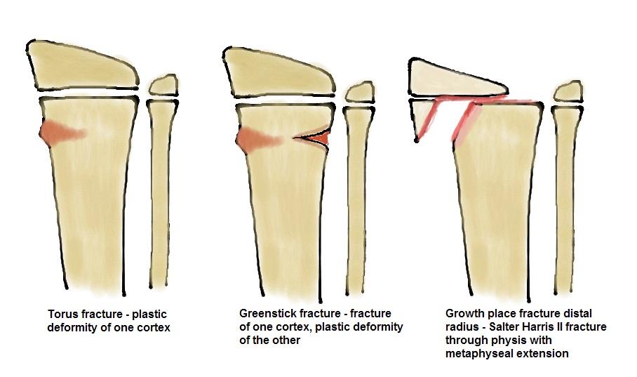 Fractuurleer MedNotez