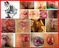 Foto Cari Obat Ambeyen Luar Keluar Benjolan