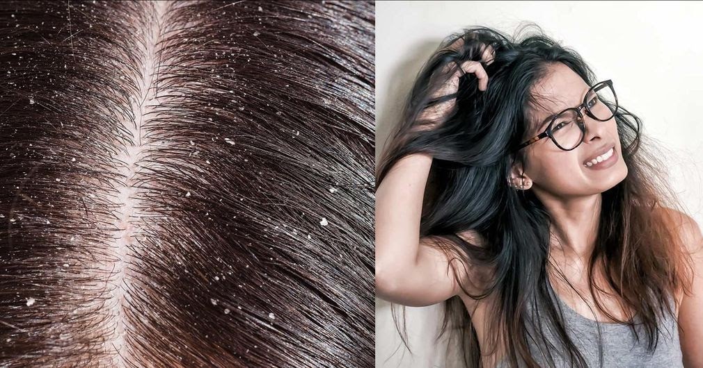 Simple Natural Remedies That Will Make Dandruff go Away Business tips