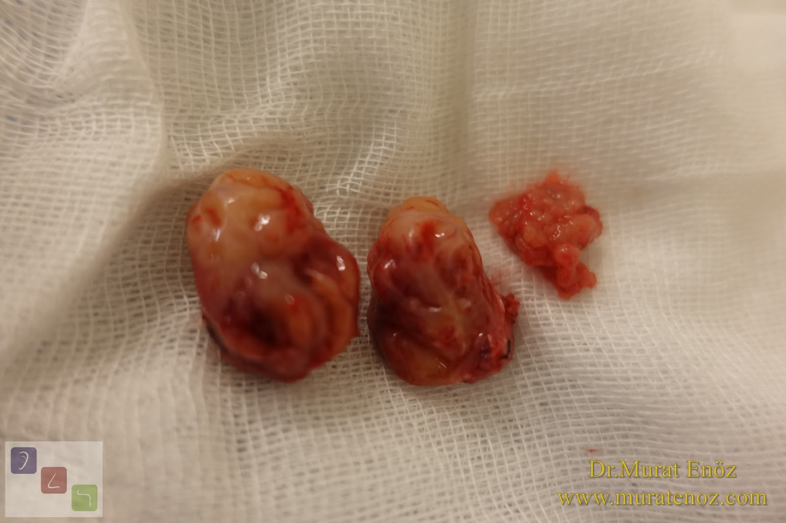 Bademcik Ameliyatı ve Geniz Eti Ameliyatı Kimler İçin Gereklidir?