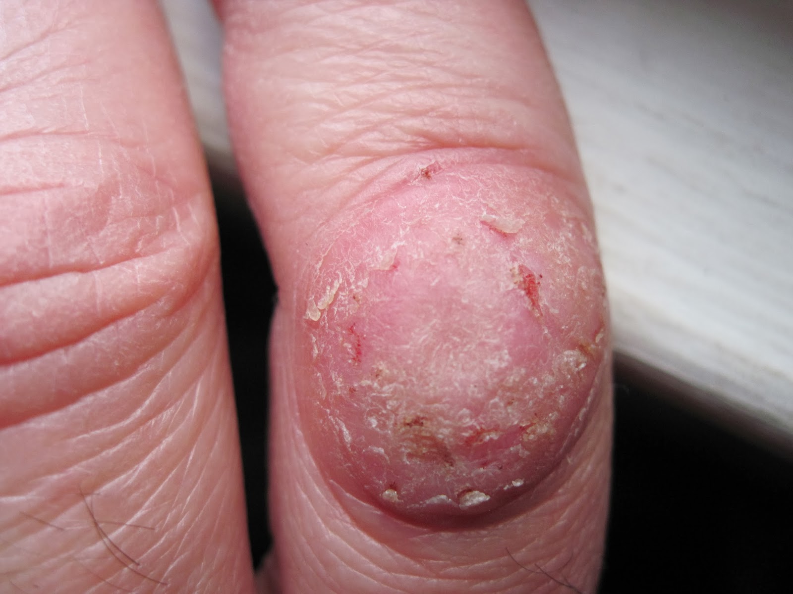 Thoughts of a Square Peg on a Round World How I've Lived With Skin